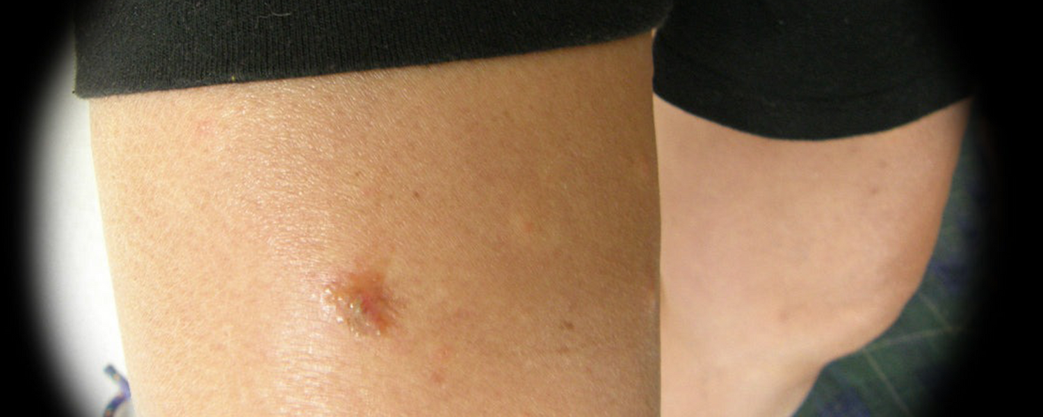 BJJ Staph Infection: Everything You Need To Know